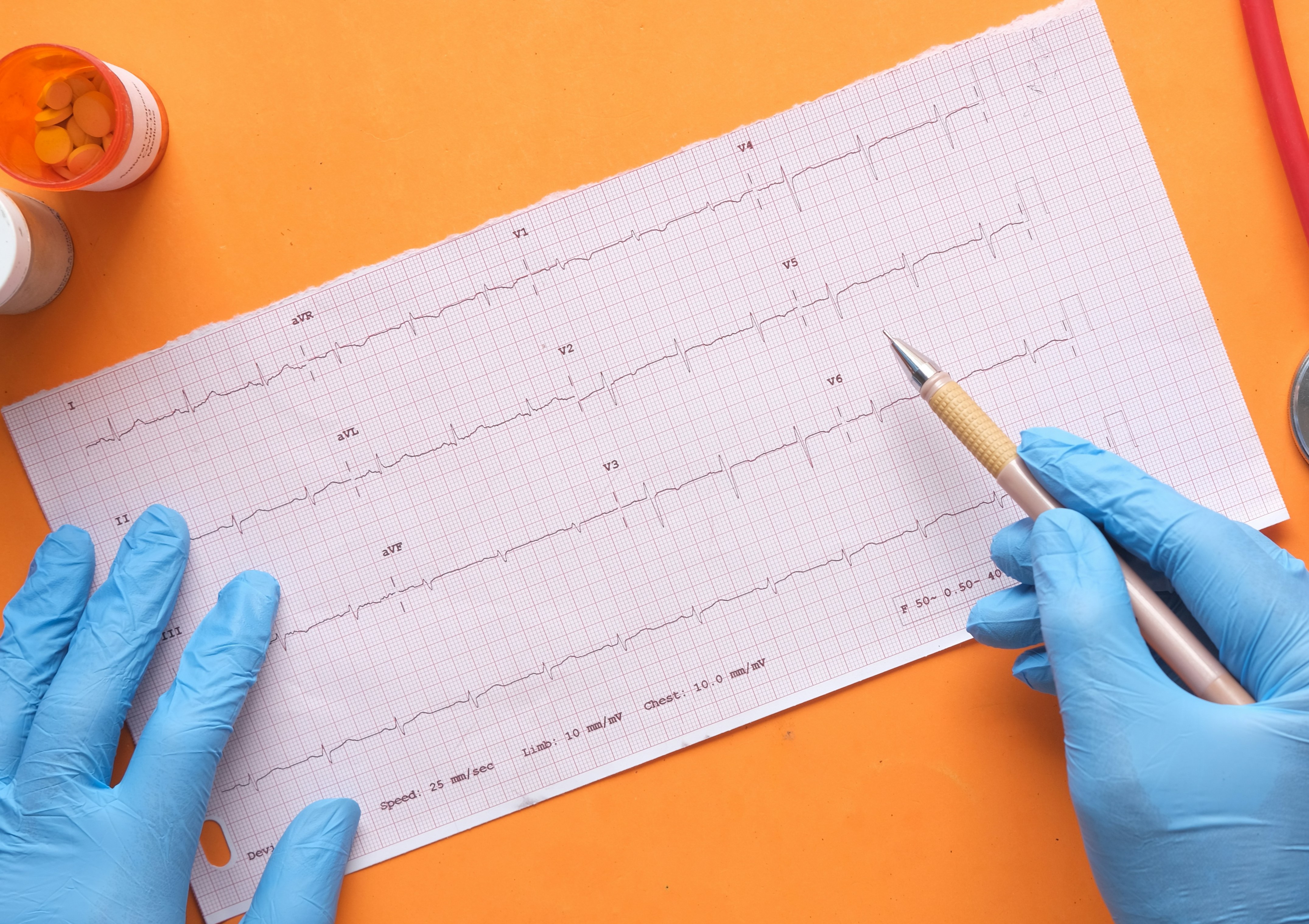 ECG report Neonat Health Surat